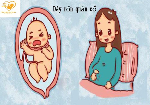 Dây rốn quấn cổ và những điều mẹ bầu cần biết