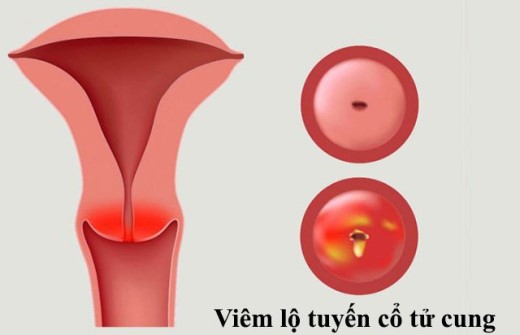 Đốt laser điều trị viêm lộ tuyến cổ tử cung