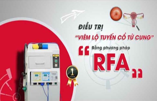 Đốt viêm lộ tuyến bằng sóng cao tần – phương pháp điều trị bệnh mới