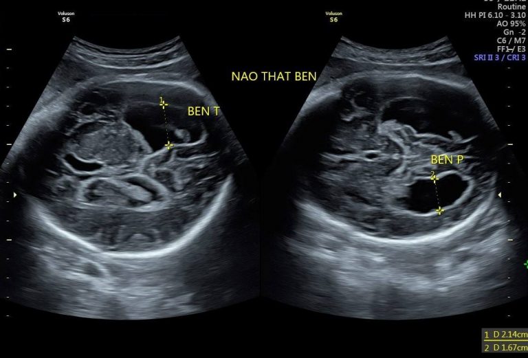 Giãn não thất bên mẹ bầu cần làm gì?
