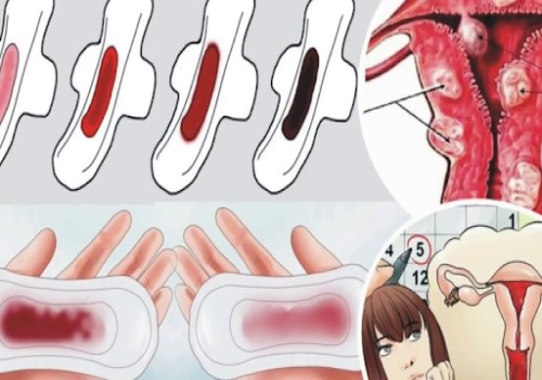 Màu sắc kinh nguyệt cảnh báo sức khỏe của bạn như thế nào ?