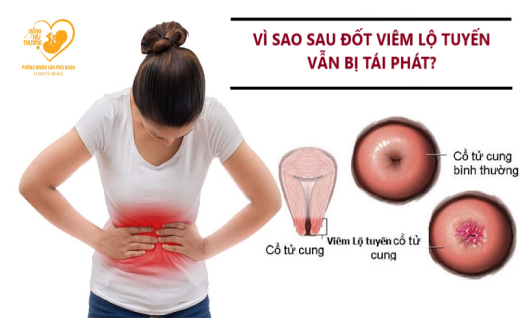 Vì sao đốt viêm lộ tuyến rồi mà vẫn bị tái phát?