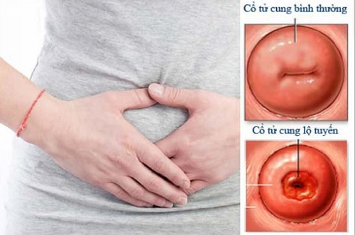Những điều cần biết về đốt viêm lộ tuyến cổ tử cung