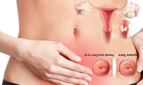 Bị nang Naboth cổ tử cung có nguy hiểm không?