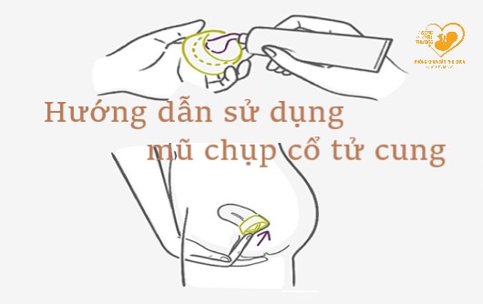 Hướng dẫn cách sử dụng mũ chụp cổ tử cung để tránh thai