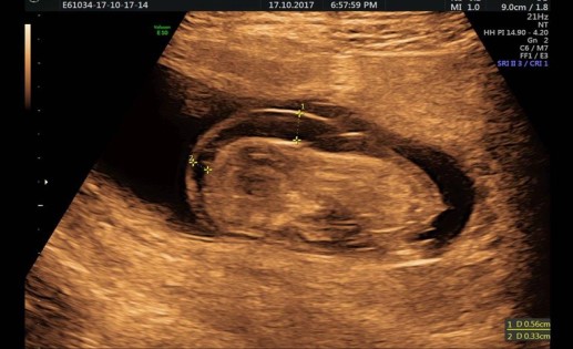 Hội chứng Hygroma kystique nguy hiểm như thế nào đối với thai phụ