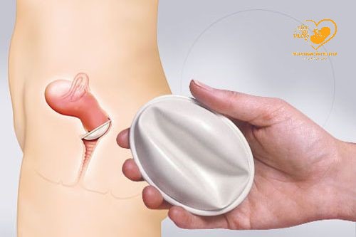 Những điều cần lưu ý khi sử dụng màng ngăn âm đạo