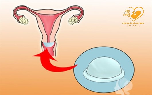 Màng ngăn âm đạo là gì? Ưu nhược điểm của màng ngăn âm đạo