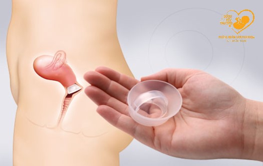 Mũ chụp cổ tử cung là gì và sử dụng như thế nào?