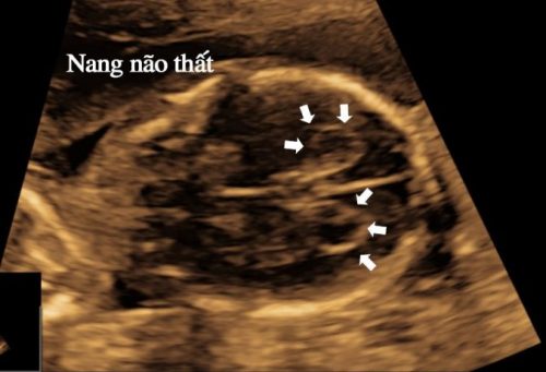 Nang đám rối màng mạch và những điều mẹ bầu cần biết
