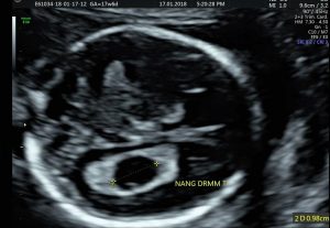 Nang đám rối màng mạch và những điều mẹ bầu cần biết