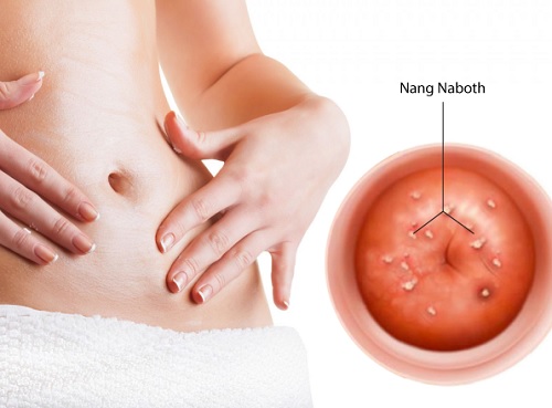 Nang Naboth là gì? Dấu hiệu nhận biết?