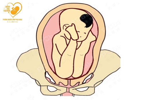 3 kiểu ngôi thai bất thường hay gặp trong thai kỳ