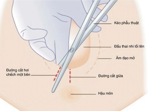Cách chăm sóc vết rạch tầng sinh môn khi sinh thường
