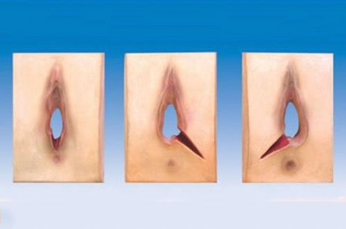 Vệ sinh vết khâu tầng sinh môn tại nhà như thế nào?