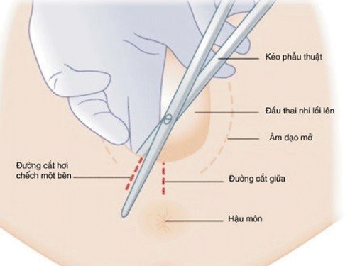 Vệ sinh vết khâu tầng sinh môn tại nhà như thế nào?