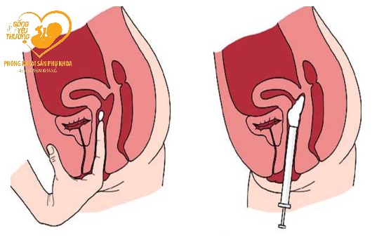 Giải đáp thắc mắc về chất diệt tinh trùng