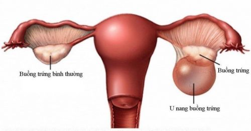 U bì buồng trứng là gì?