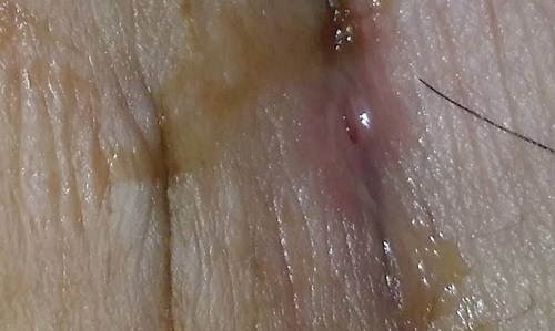 Dấu hiệu rách vết khâu tầng sinh môn bạn nên biết