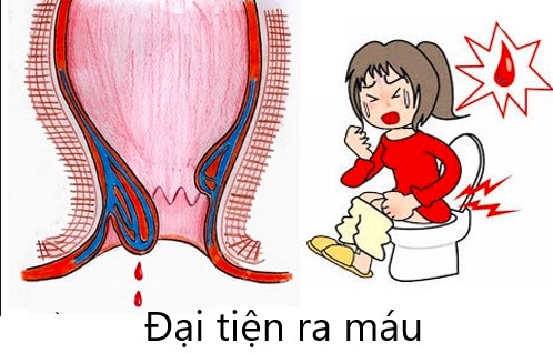 Bệnh trĩ – Căn bệnh khó nói của rất nhiều mẹ bầu