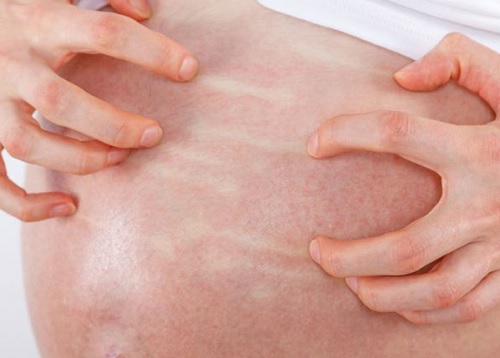 Bị ngứa khi mang thai mẹ bầu cần làm gì?