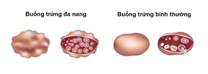 buồng trứng đa nang, phòng khám 43 Nguyễn Khang