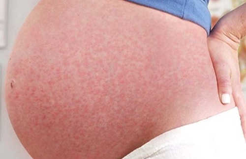 Nguyên nhân, triệu chứng nổi mầy đay khi mang thai?