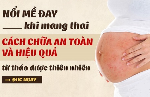Nổi mề đay khi mang thai có nguy hiểm không?