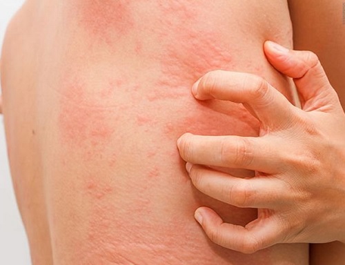 Nổi mề đay có lây không?