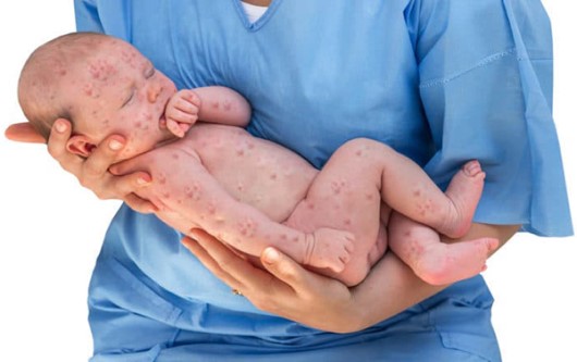 Ảnh hưởng của bệnh Rubella đối với mẹ bầu, thai nhi và trẻ sơ sinh