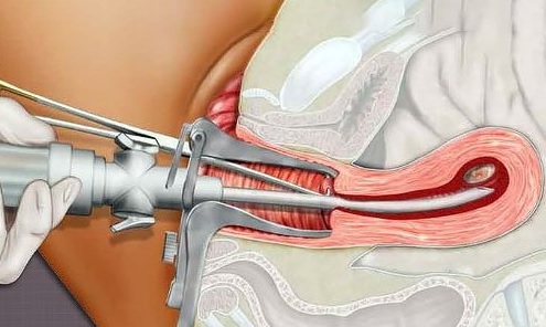 Hút thai chân không-những điều cần biết