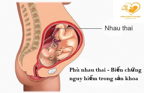 Phù rau thai - Biến chứng sản khoa nguy hiểm