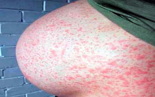 Nhiễm rubella và thai nghén
