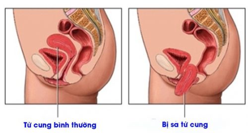 3 cấp độ sa sinh dục và phương pháp điều trị