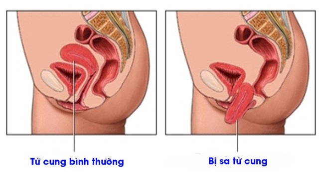 Sa sinh dục và các phương pháp dự phòng