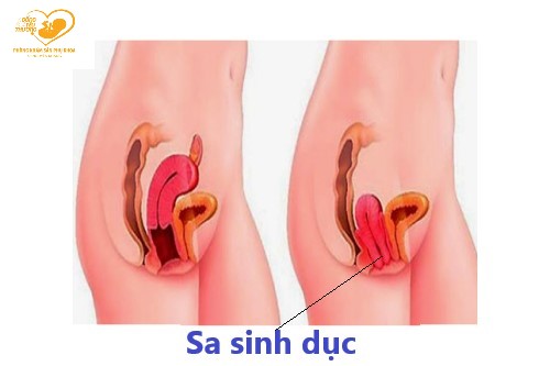 Sa sinh dục và các phương pháp dự phòng