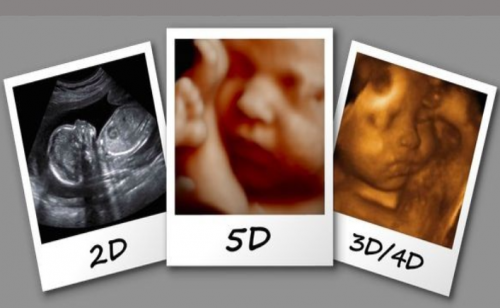Sự khác biệt giữa siêu âm 2D và 3D