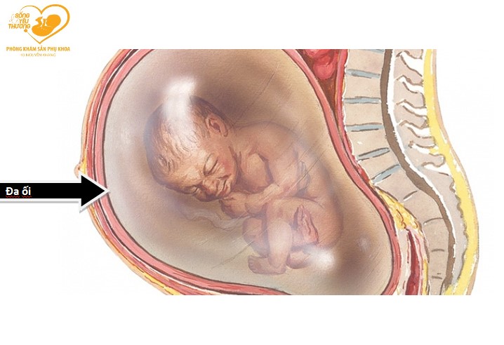 Dư ối và đa ối khác nhau như thế nào?
