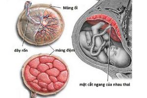 Phù nhau thai - biến chứng sản khoa nguy hiểm