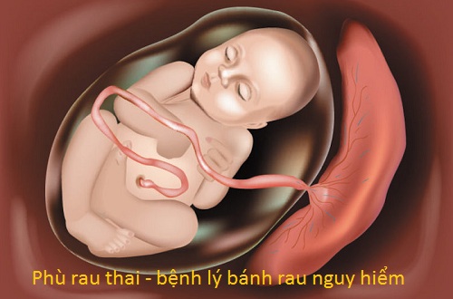 Phù rau thai – bệnh lý bánh rau nguy hiểm