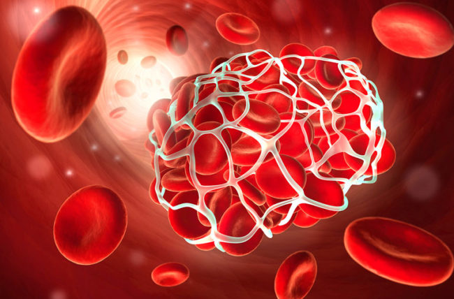 hội chứng kháng phospholipid là gì