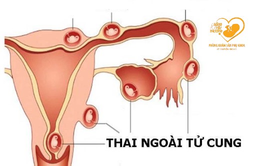 Mang thai ngoài tử cung và những điều bạn cần biết