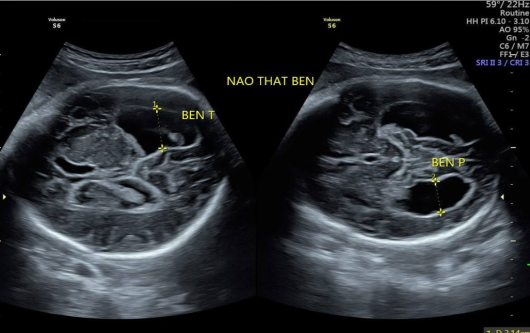 Giãn não thất bên ở thai nhi những điều mẹ cần lưu ý