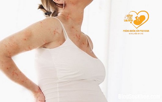 Viêm da cơ địa khi mang thai có ảnh hưởng đến thai nhi không