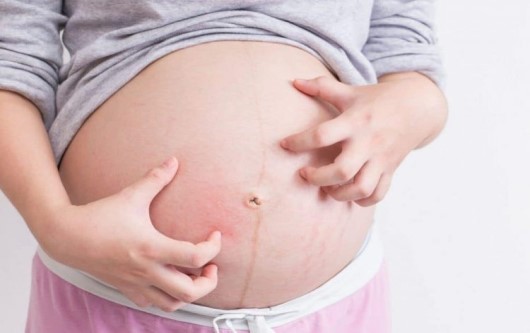 Hội chứng hellp - một biến thể của tiền sản giật