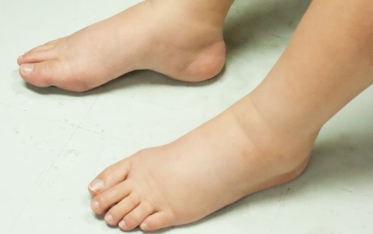 phù chân khi mang thai là bình thường hay bất thường, tiền sản giật