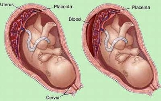 Tụ dịch dưới màng nuôi có tự hết không?