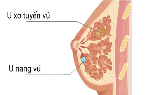 Giải đáp thắc mắc: U xơ tuyến vú và thai nghén
