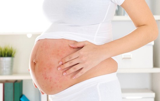 Lưu ý cho mẹ bầu mắc viêm da cơ địa
