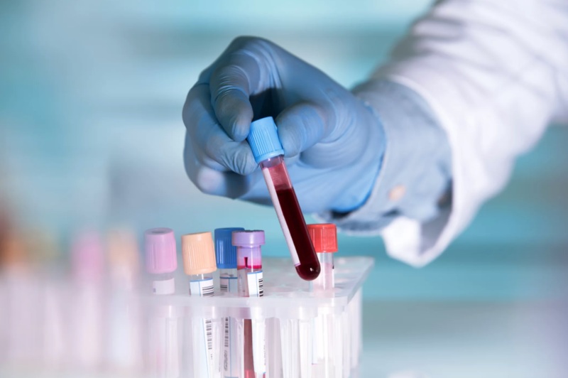 chẩn đoán hội chứng kháng phospholipid